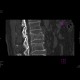 Compression fracture of lumbar vertebra: CT - Computed tomography